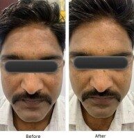 HydraFacial Before After