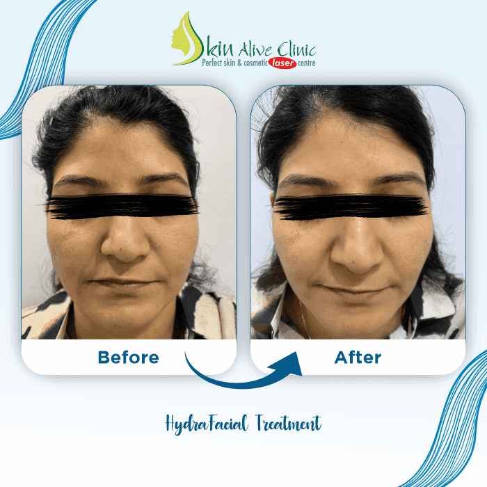 HydraFacial before after
